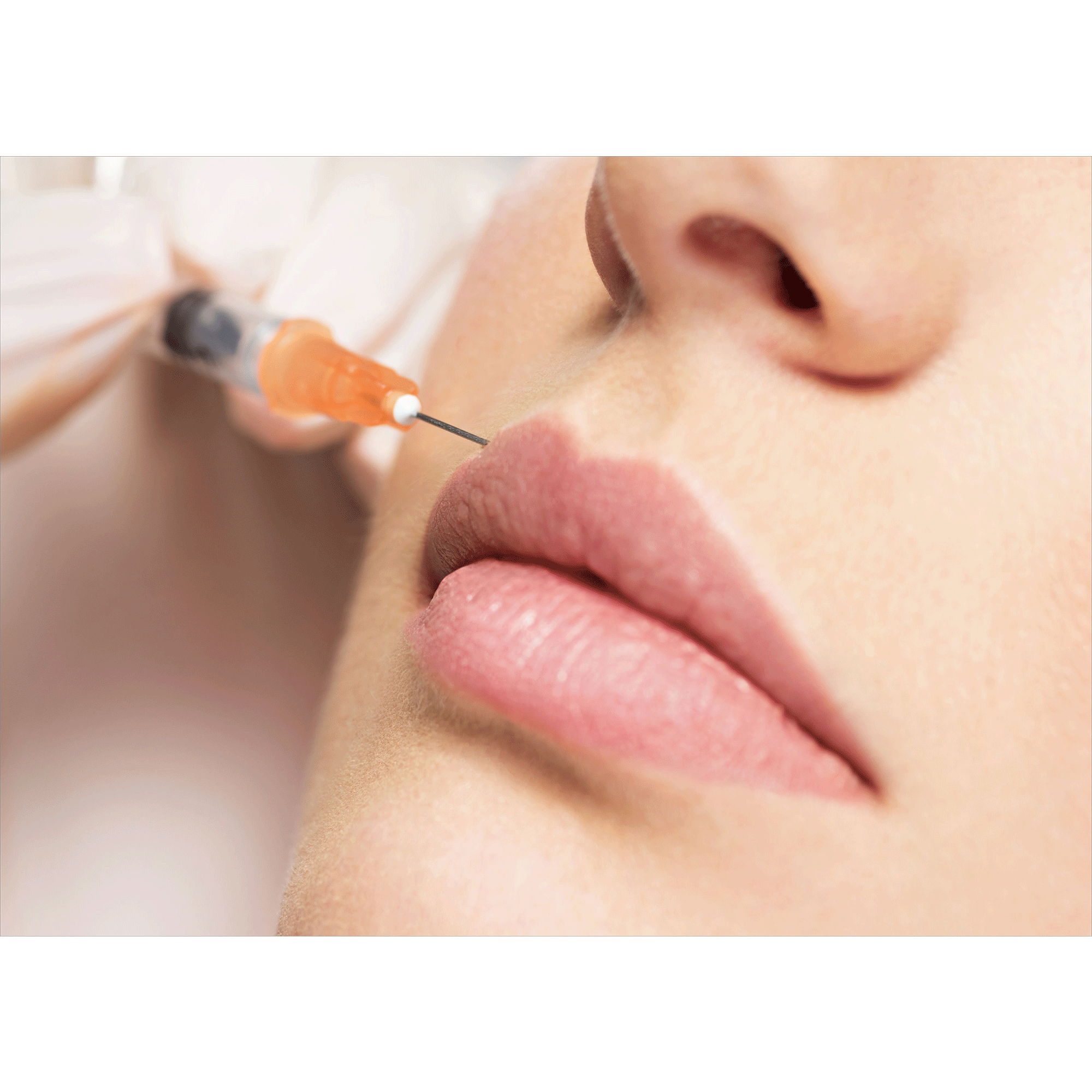 Lip Filler – Beauty Fix MedSpa